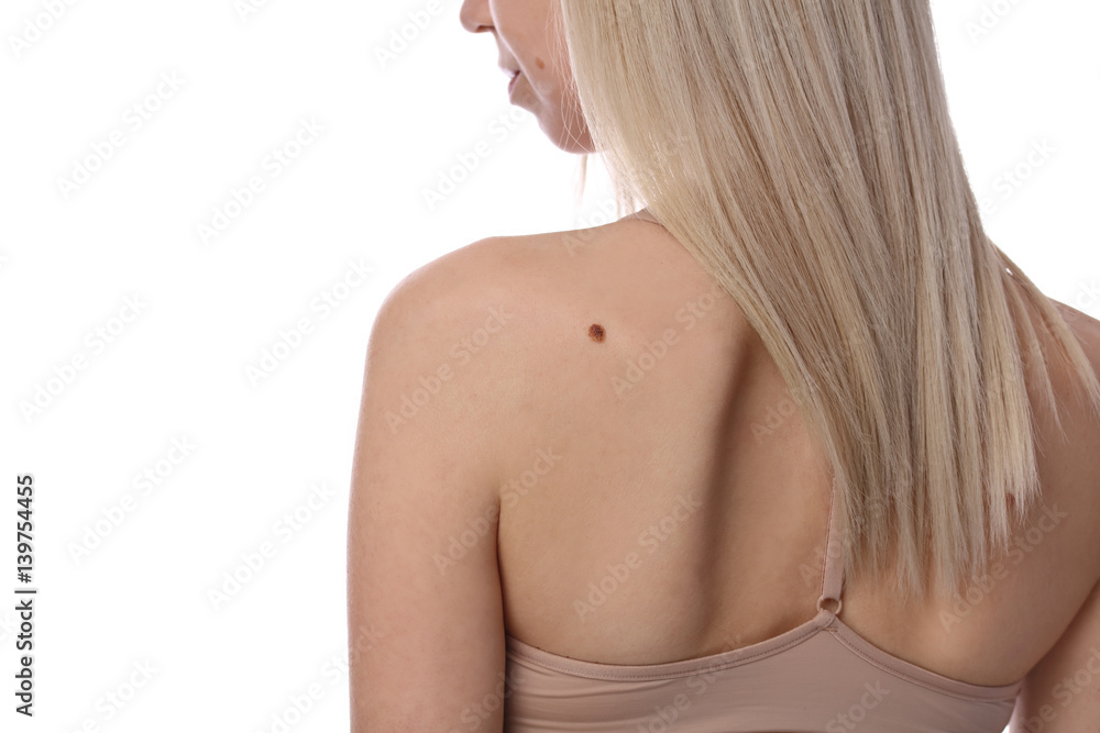 Young woman with birthmarks on her back and face isolated on white background. Dermatology, Checking benign moles. Skin tags removal concept Young woman with birthmarks on her back and face isolated on white background. Dermatology, Checking benign moles. Skin tags removal concept