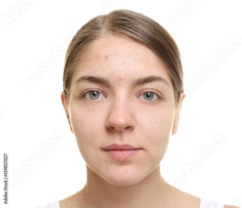 Фотография Beautiful young woman with problem skin on white background