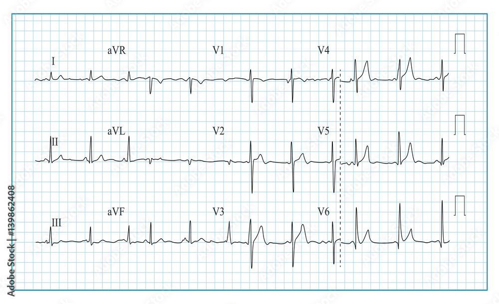 Heart Cardiogram Chart Vector. Illustration Of Wave Form On Checked Ecg Graph. Heart Rhythm, Ischemia, Infarction. Vitality Heartbeat