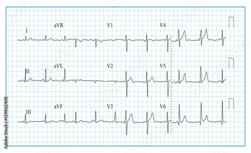 Heart Cardiogram Chart Vector. Illustration Of Wave Form On Checked Ecg Graph. Heart Rhythm, Ischemia, Infarction. Vitality Heartbeat
