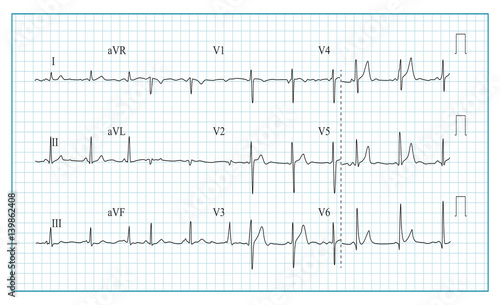 Heart Cardiogram Chart Vector. Illustration Of Wave Form On Checked Ecg Graph. Heart Rhythm, Ischemia, Infarction. Vitality Heartbeat
