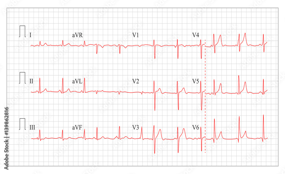 Heart Cardiogram Chart Vector. Set Healthy Heart Rhythm, Ischemia, Infarction. Vitality Heartbeat, Heart Electrocardiogram, Pulse Line