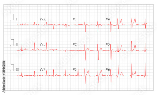 Heart Cardiogram Chart Vector. Set Healthy Heart Rhythm  Ischemia  Infarction. Vitality Heartbeat  Heart Electrocardiogram  Pulse Line