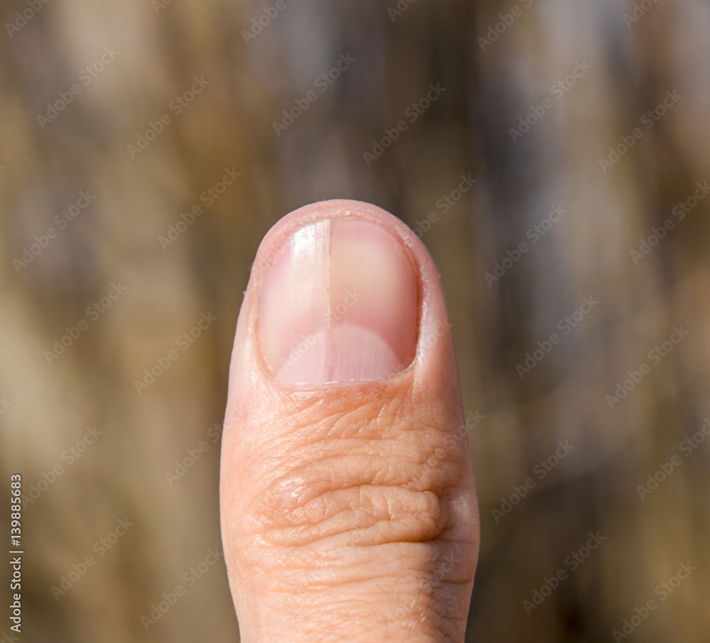 Forked nail on the thumb. Dilation of the nail, traumatic pathology. The nail is divided in half Forked nail on the thumb. Dilation of the nail, traumatic pathology. The nail is divided in half