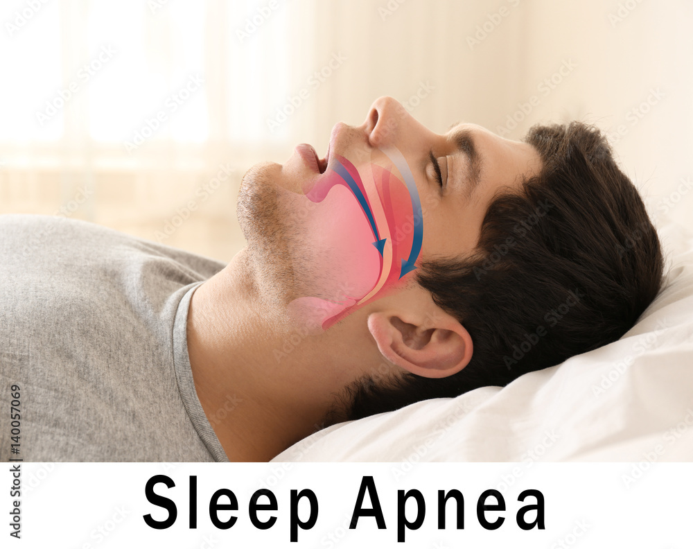 Snore problem concept. Illustration of obstructive sleep apnea - obrazy, fototapety, plakaty 