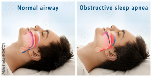 Snore problem concept. Illustration of normal airway and obstructive sleep apnea