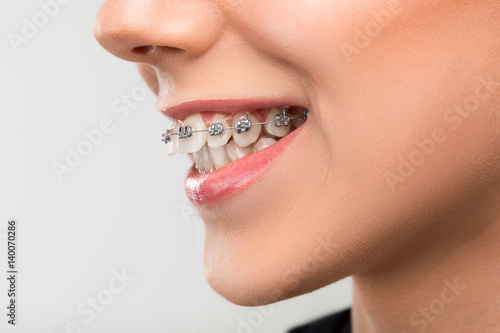 Beautiful young woman with teeth braces photo