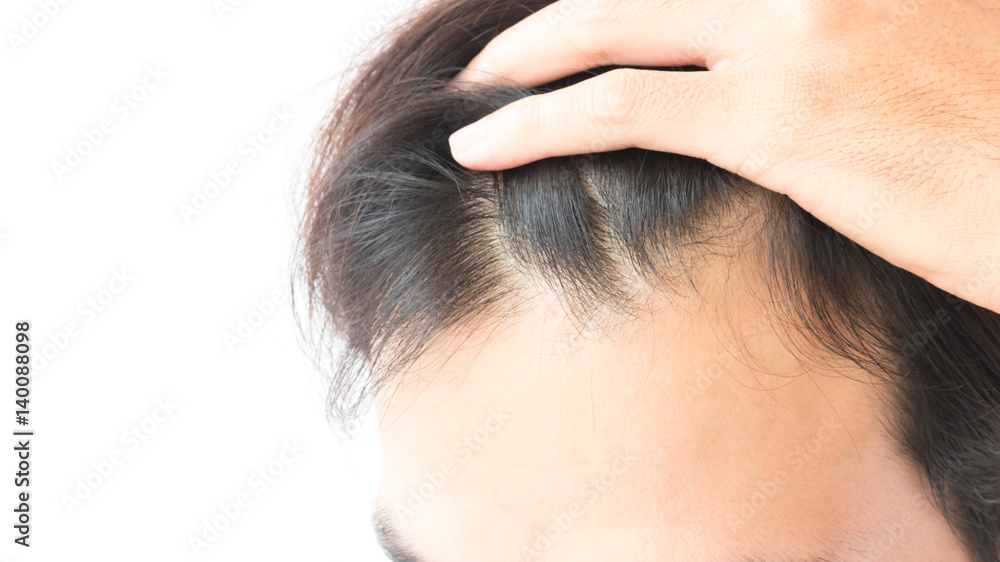 Fototapeta premium Young man serious hair loss problem for health care shampoo and beauty product concept