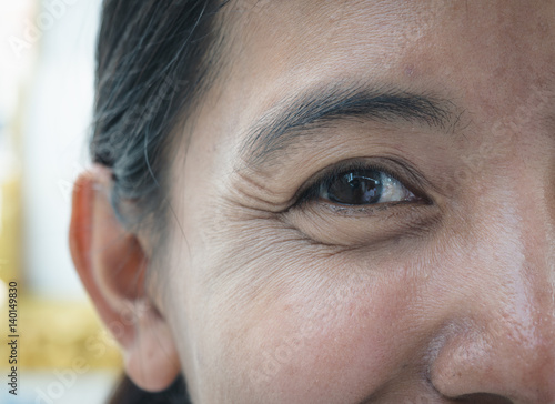 Wrinkles circles around eye from smile