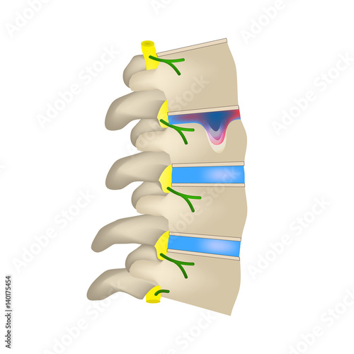 Hernia Schmorl. Intervertebral disc. Side view. Spine. Infographics Vector illustration on isolated background