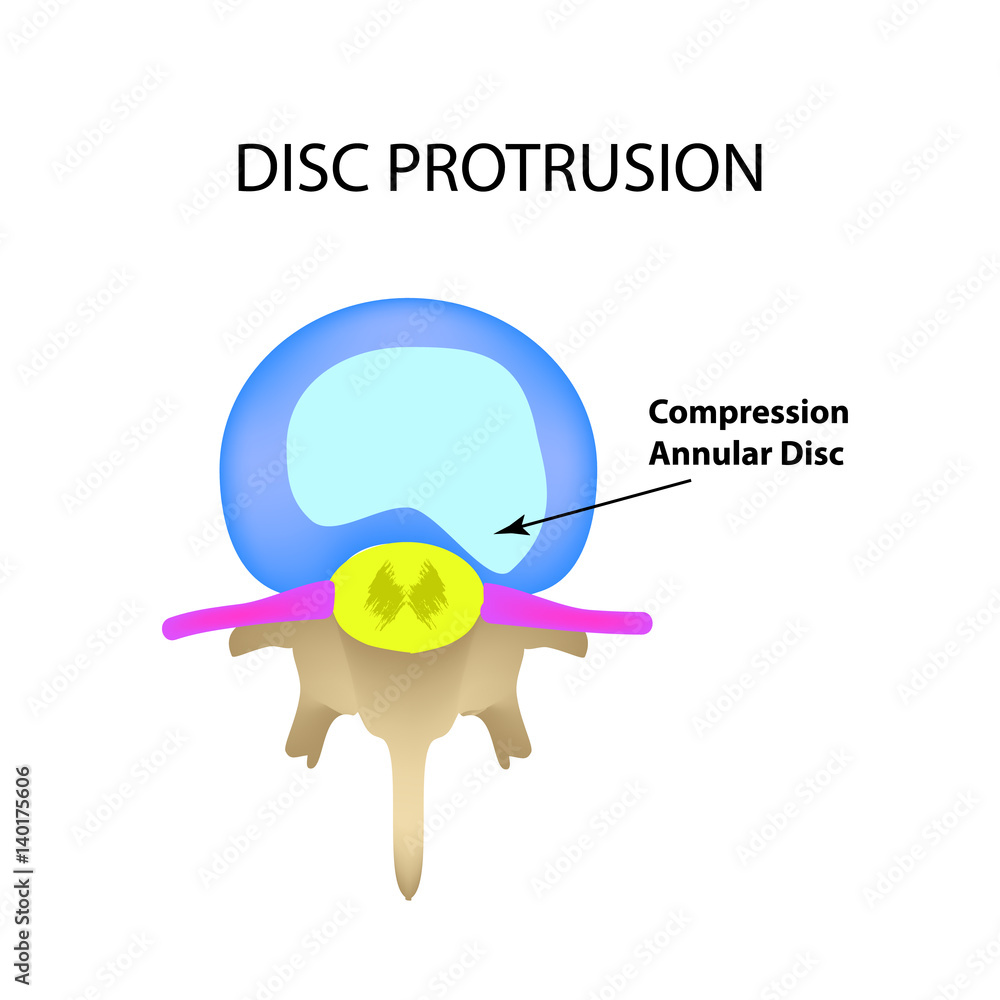 Disc protrusion. Top view. Spine. Infographics. Vector illustration on
