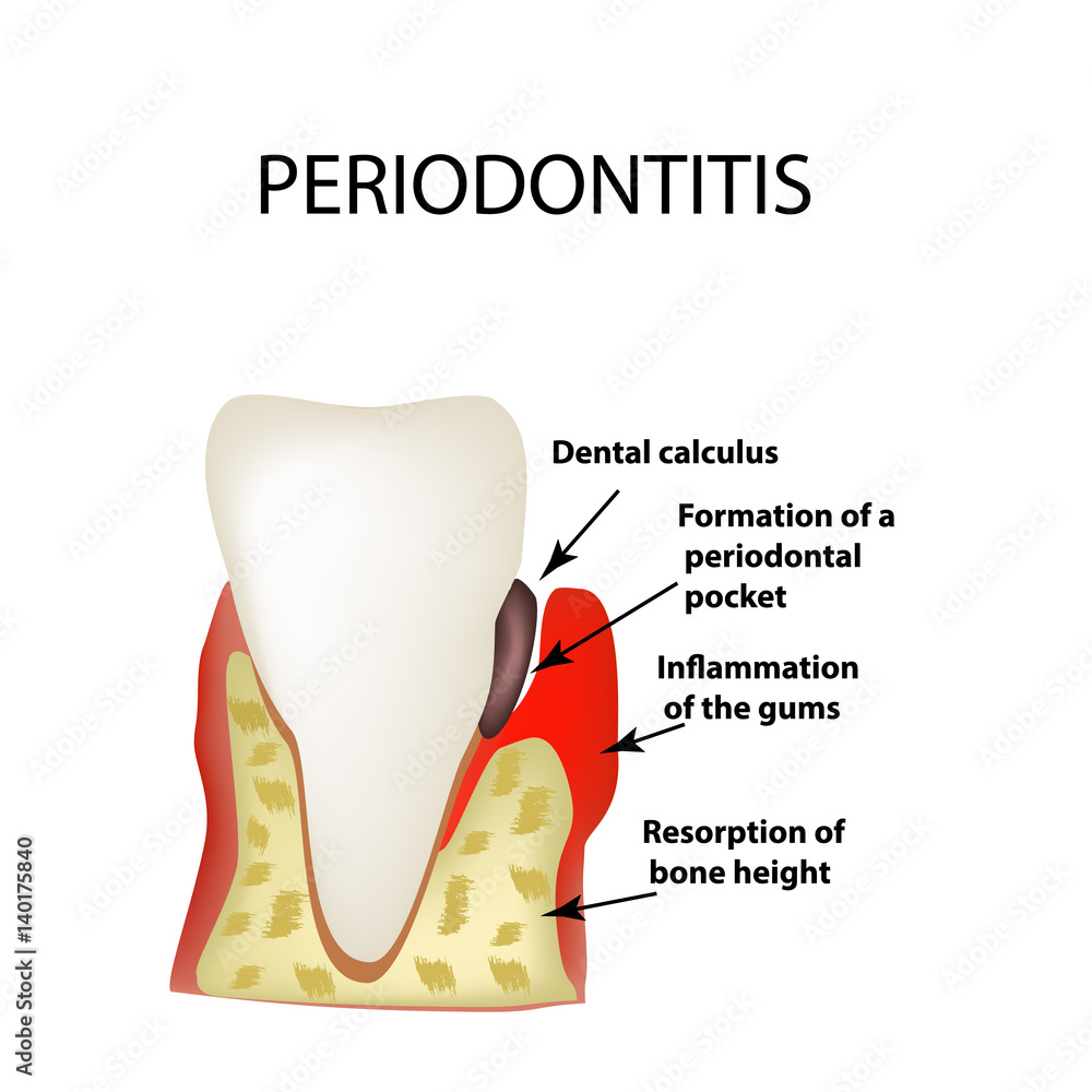 Periodontitis. dental disease. Inflammation of the gums and the tooth