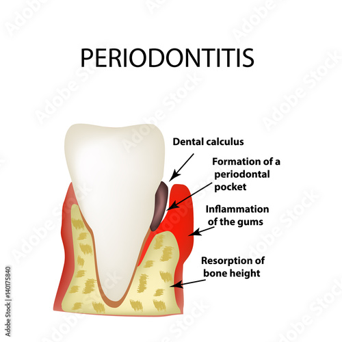 Periodontitis. dental disease. Inflammation of the gums and the tooth stone. Infographics. Vector illustration on isolated background