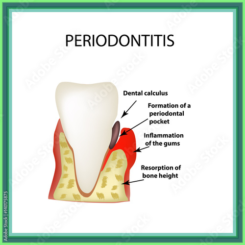 Periodontitis. dental disease. Inflammation of the gums and the tooth stone. Infographics. Vector illustration on isolated background