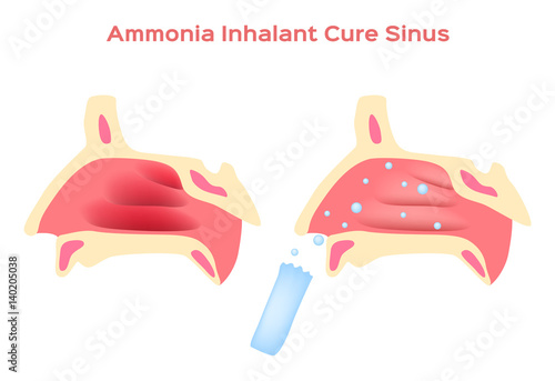 Ammonia Inhalant cure nasal cavity