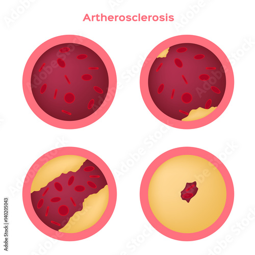 step of Atherosclerosis icon and vector . fat stuck in the blood artery  cholesterol