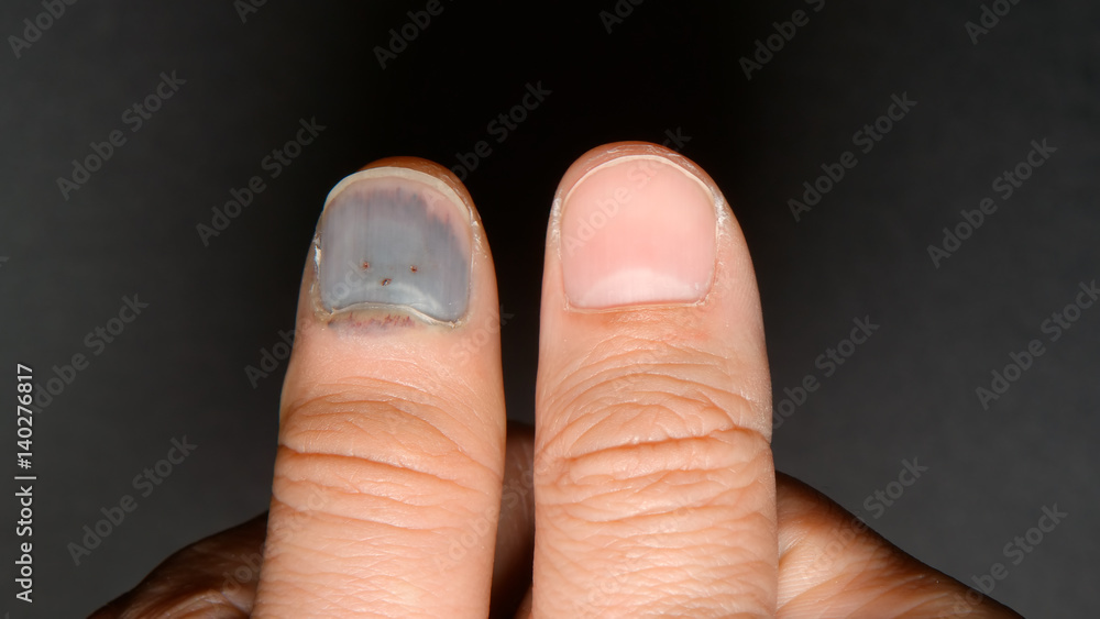 Blackened and healthy nails - Center