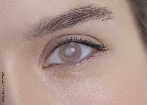 Eye of a woman with cataract and corneal opacity photo