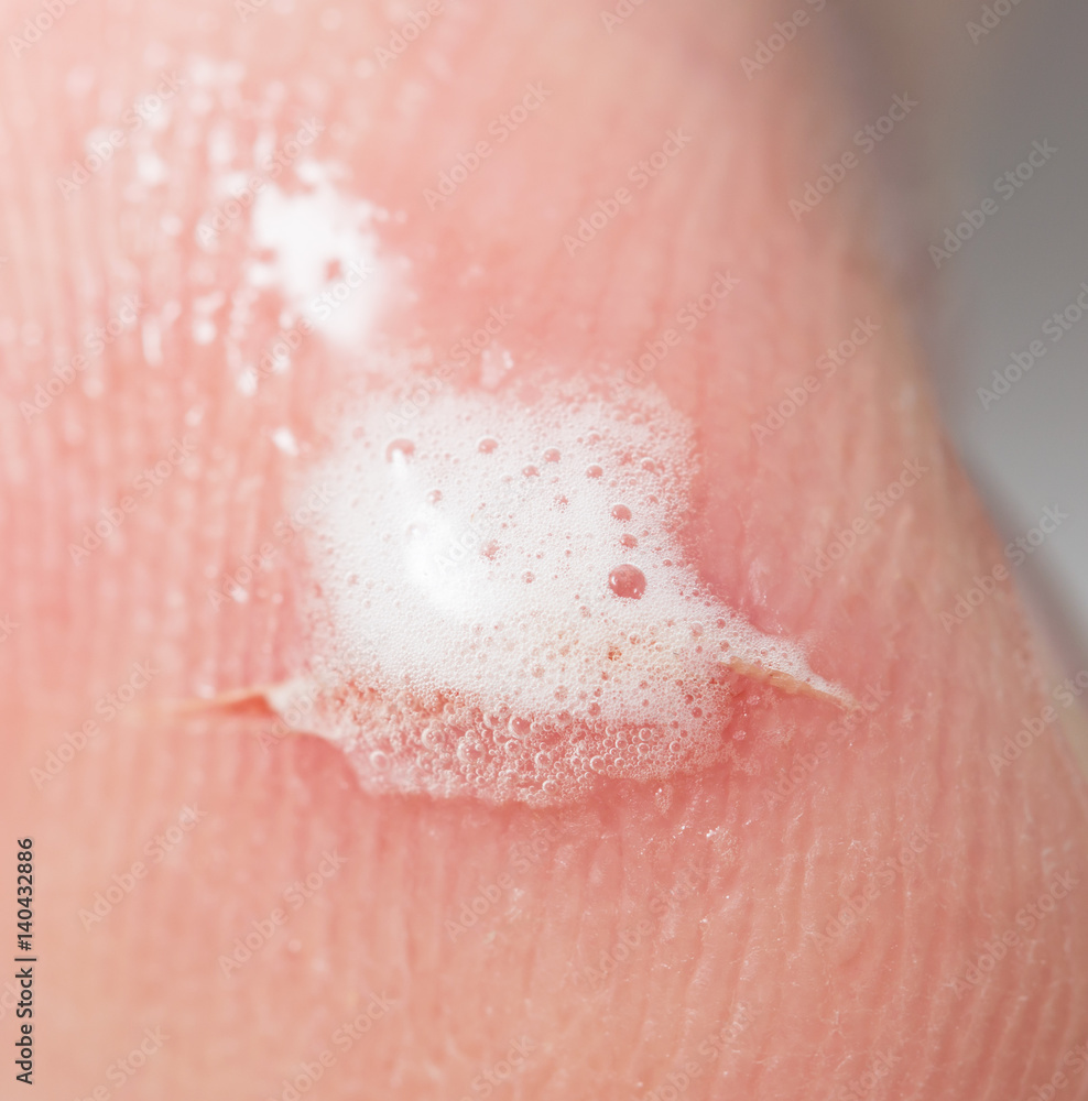Fototapeta premium cut on the skin