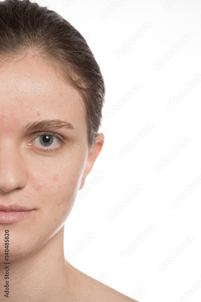 Beautiful young girl with red and white acne on her face. Before and after cream with sponge on a white background. Beautiful young girl with red and white acne on her face. Before and after cream with sponge on a white background.