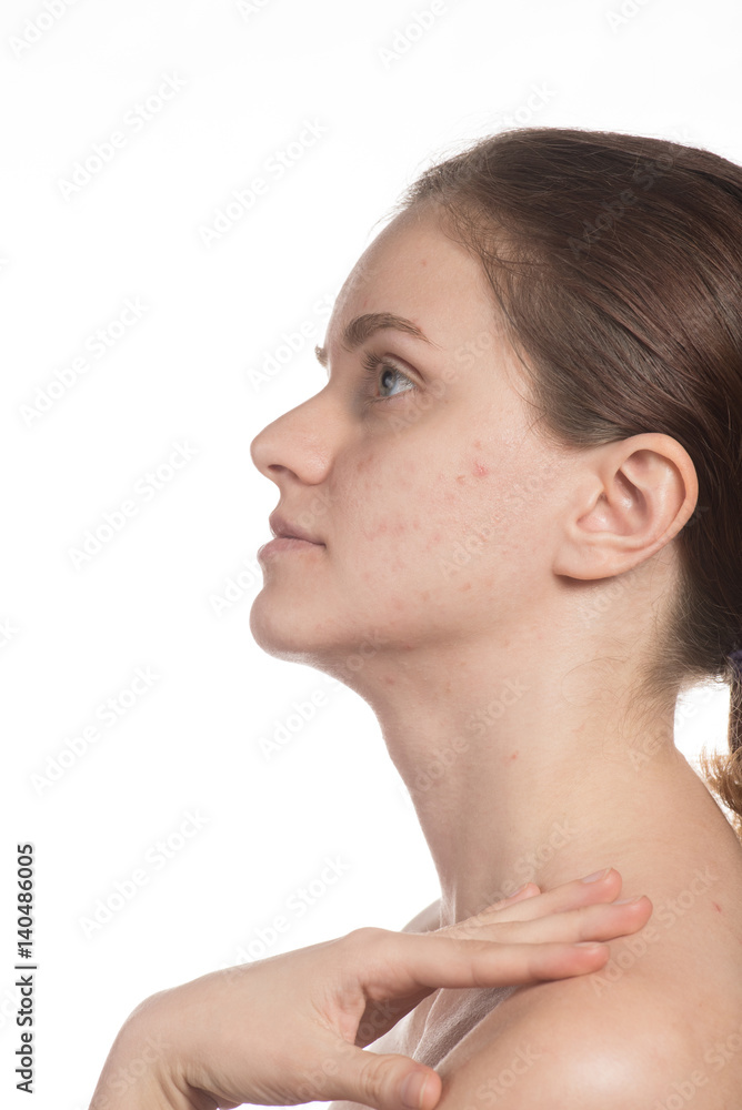 Beautiful young girl with red and white acne on her face. Before and after cream with sponge on a white background. Beautiful young girl with red and white acne on her face. Before and after cream with sponge on a white background.
