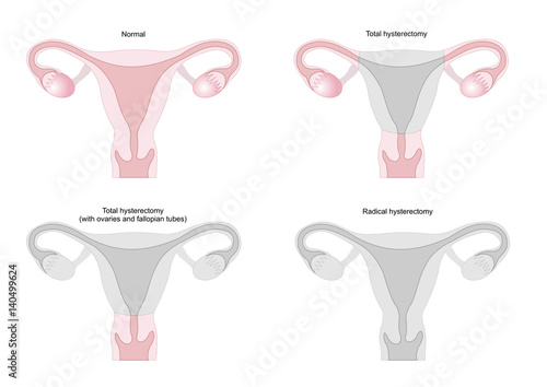 Hysterectomy, surgical removal of the uterus and, in some cases, of ovaries, fallopian tubes and cervix