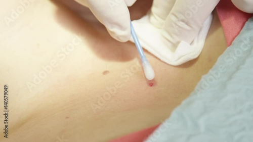 EXTREME CLOSE UP: Bleeding wound after surgical removal of birthmark on the skin of a young woman. Disinfecting cut after dermatological procedure of removing beauty mark on the neck of a patient