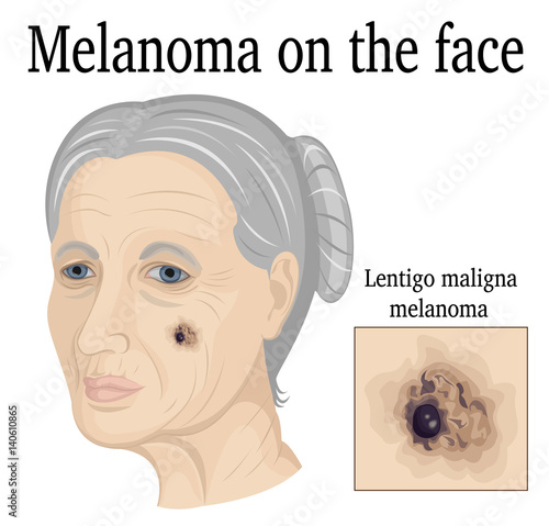 Melanoma on the face