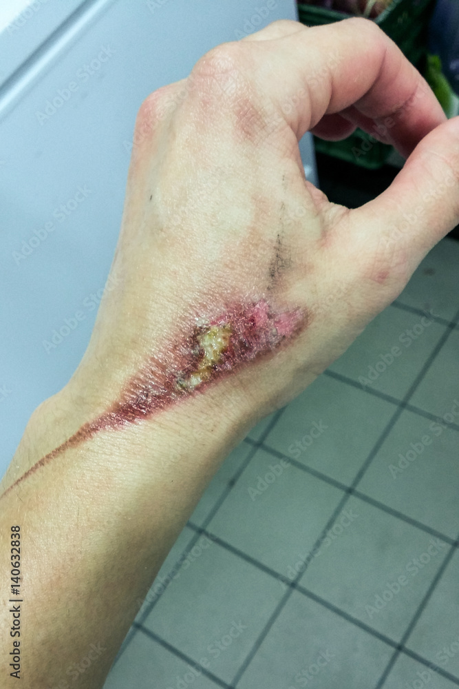 custom made wallpaper toronto digitalHorrible burns on female hand, lack of observance of safety precautions in cooking process
