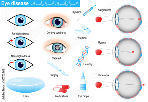 human eye diseases and disorders. Infographic