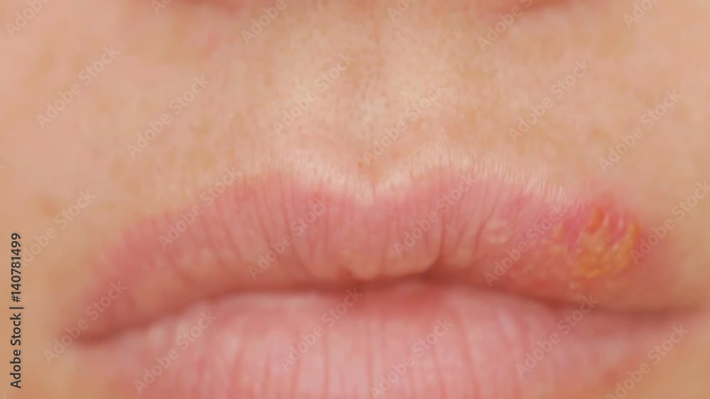 girl touching sores on the lips. herpes. lip treatment Stock 비디오