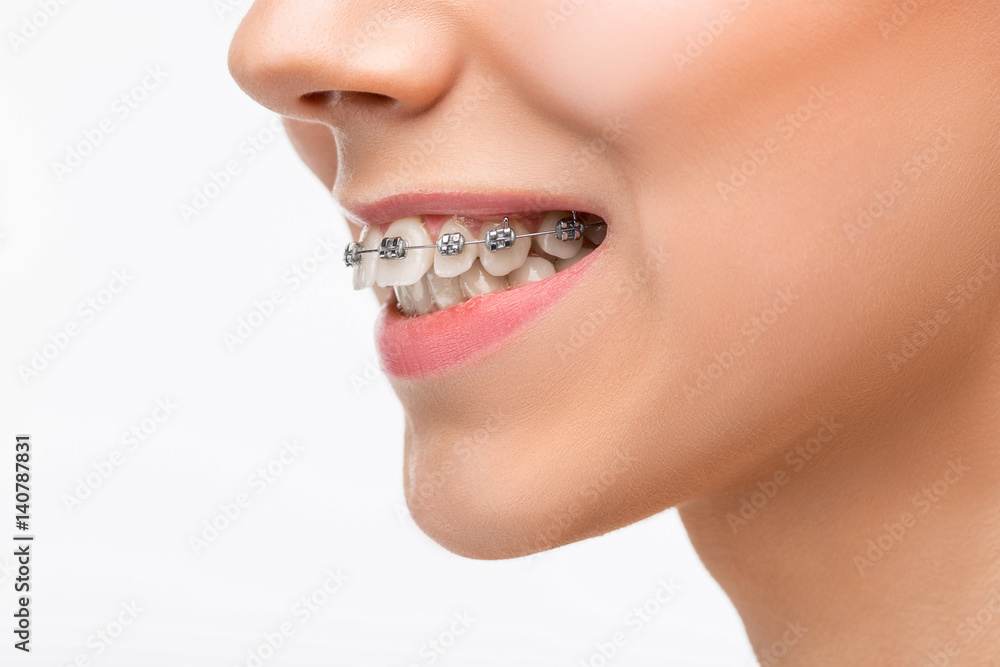 Fototapeta premium Piękna młoda kobieta z szelkami zębów