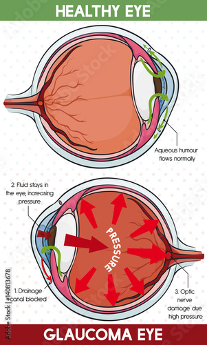 Comparative Information Between Healthy Eye and Glaucoma Eye, Vector Illustration
