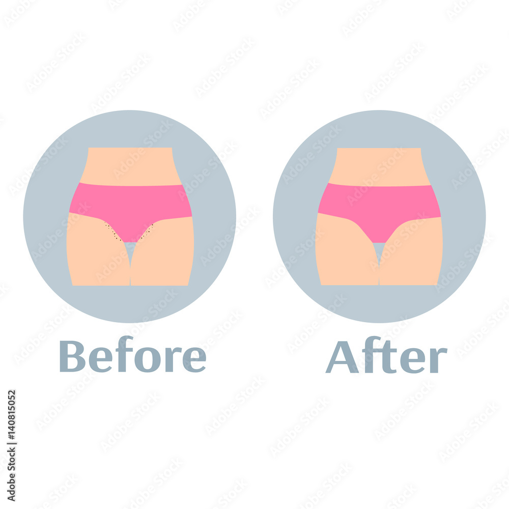 Before and after depilation bikini zone