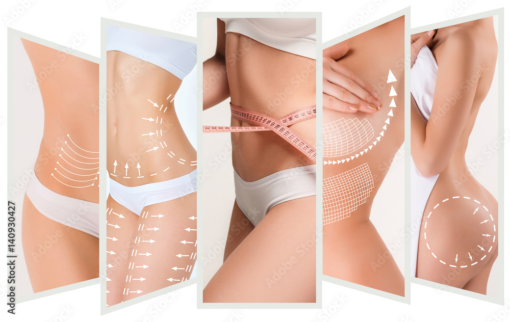 The cellulite removal plan. White markings on young woman body - obrazy, fototapety, plakaty 