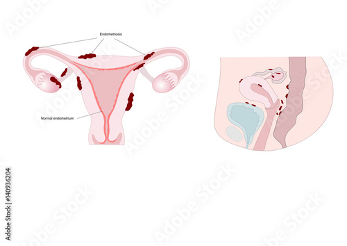 endometriosis: main locations of abnormal tissue growth