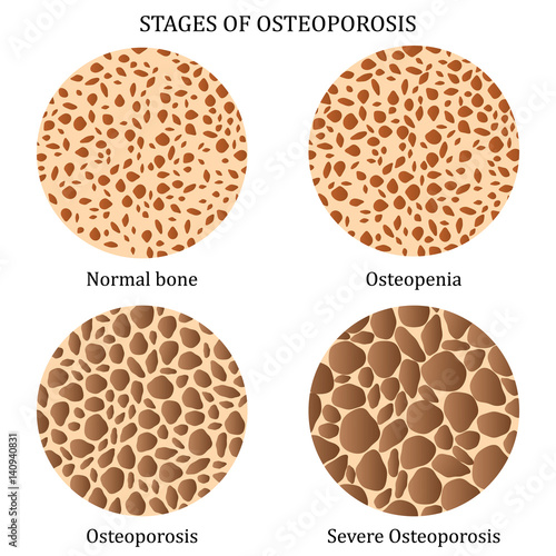 Stages of osteoporosis.