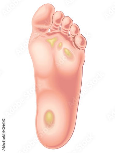 foot calluses and foot corns
