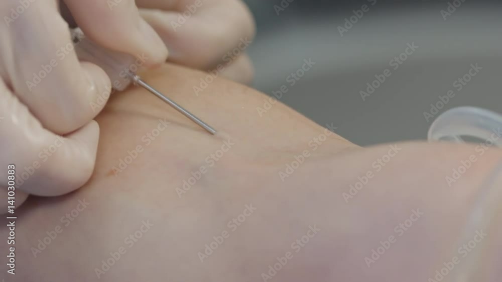 Closeup of hand of nurse preparing skin of patient with alcohol wipe and then inserting needle into vein for taking blood Closeup of hand of nurse preparing skin of patient with alcohol wipe and then inserting needle into vein for taking blood