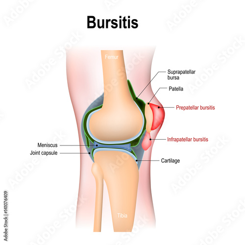 Bursitis is the inflammation of bursae