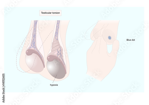 testicular torsion (torsion of the spermatic cord) can induce ischemia of the testicle