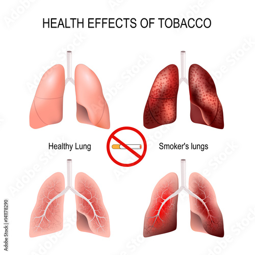 Health effects of smoking