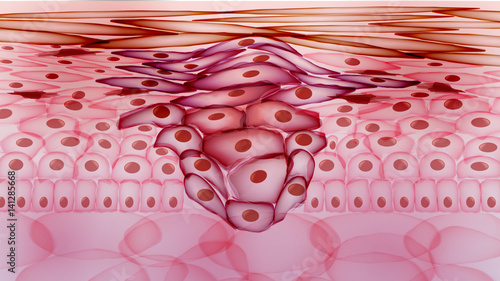 Growing Tumor, Tissue Section Inflamed Skin - Vector Illustration