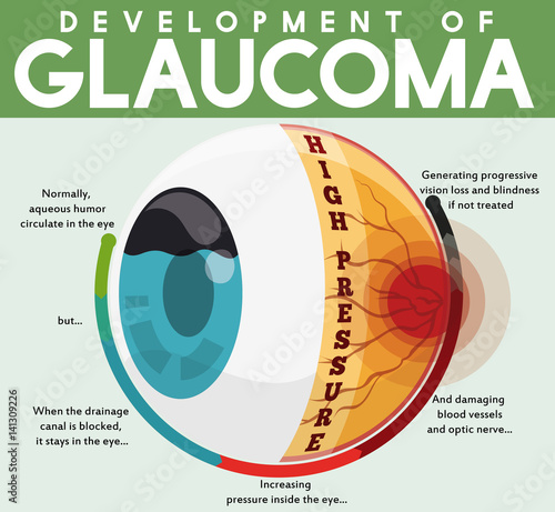 Fototapeta Naklejka Na Ścianę i Meble -  Infographic with Development of Untreated Glaucoma Disease, Vector Illustration