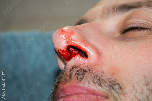 Foto Broken nose close-up The man is bleeding from the nose.