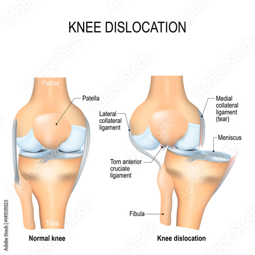 Knee dislocation and normal. photo