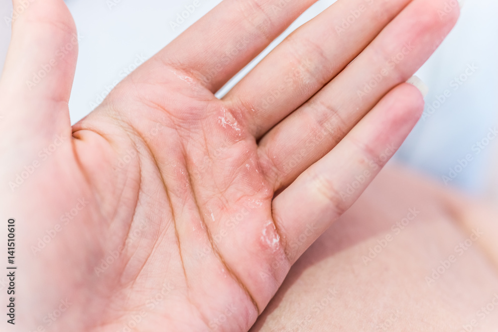Calluses on hand macro closeup from calisthenics