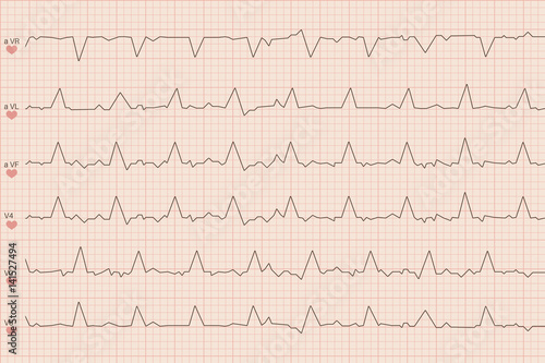 Arrhythmia electrocardiogram sheet