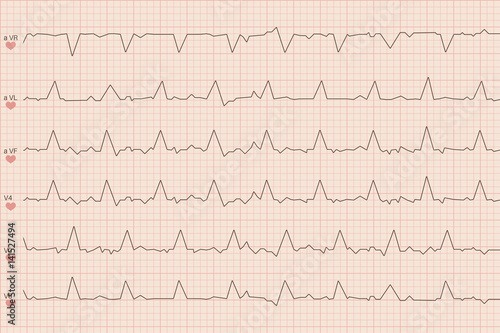 Arrhythmia electrocardiogram sheet