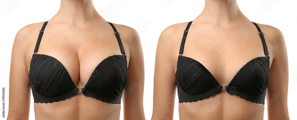 Woman before and after breast size correction on white background. Plastic  surgery concept Stock Photo